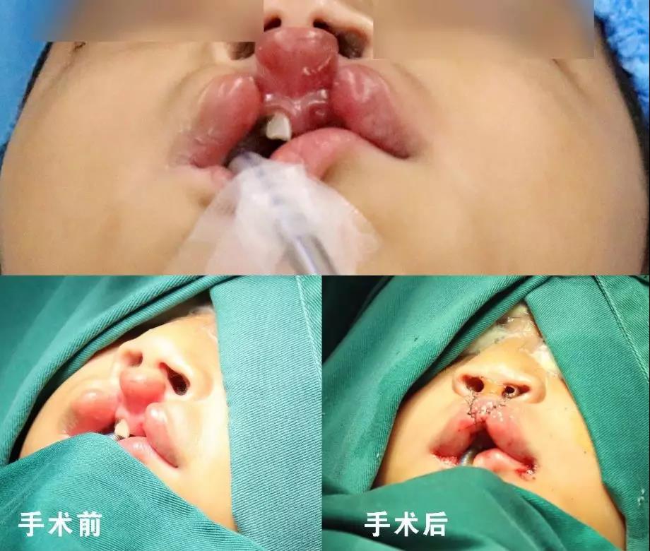唇腭裂盡早治療消除孩子自卑心理，快樂成長！