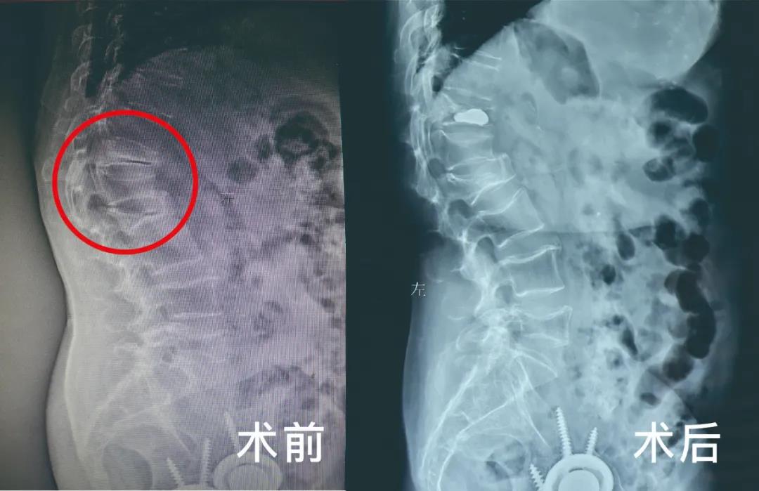 骨質(zhì)疏松導致壓縮性骨折微創(chuàng)手術療效顯著