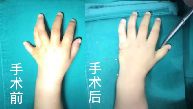 【保山安利醫(yī)院】2歲小兒手、足多指（趾）成功修復(矯正）！