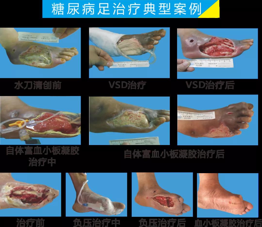 截肢、失明，甚至……，我們要做的是將糖尿病并發(fā)癥遏制在搖籃里！