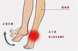 【保山安利醫(yī)院—健康科普】什么是足下垂！你了解嗎？