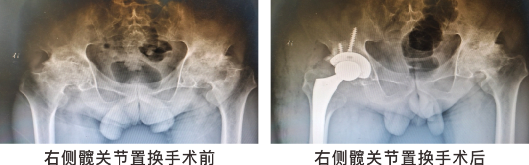【保山安利醫(yī)院】長期飲酒導致雙側(cè)股骨頭壞死，髖關節(jié)置換后重獲運動功能！