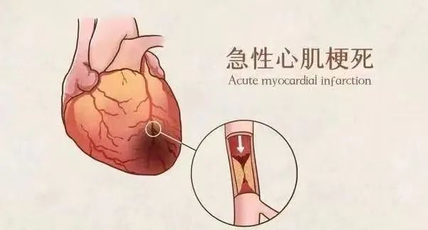 【保山安利醫(yī)院】11月20日“心梗救治日” 時(shí)間就是心肌，時(shí)間就是生命！